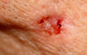 Medical-style illustration of a mild skin ulcer on the human skin surface, showing early-stage inflammation and affected tissue for educational purposes.