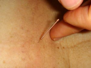 Acupuncture Therapy in Ponce Medical Acupuncture and Intravenous Therapy with Dr Antonio Gonzalez Sotomayor with Dr Antonio Gonzalez Sotomayor